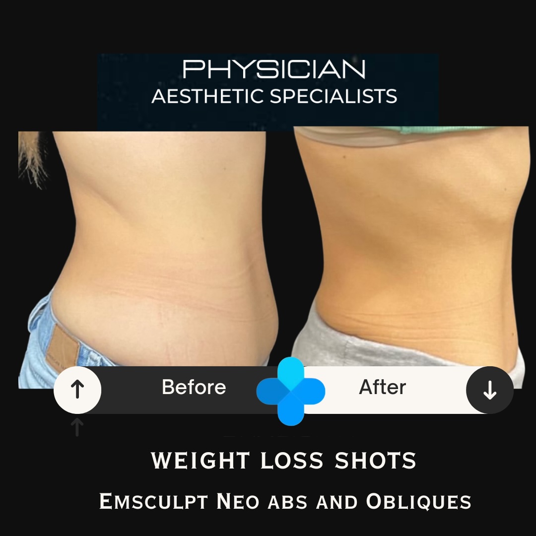 A patient's side-by-side comparison shows the results of abdominal contouring through her medical weight loss program in Lenexa.