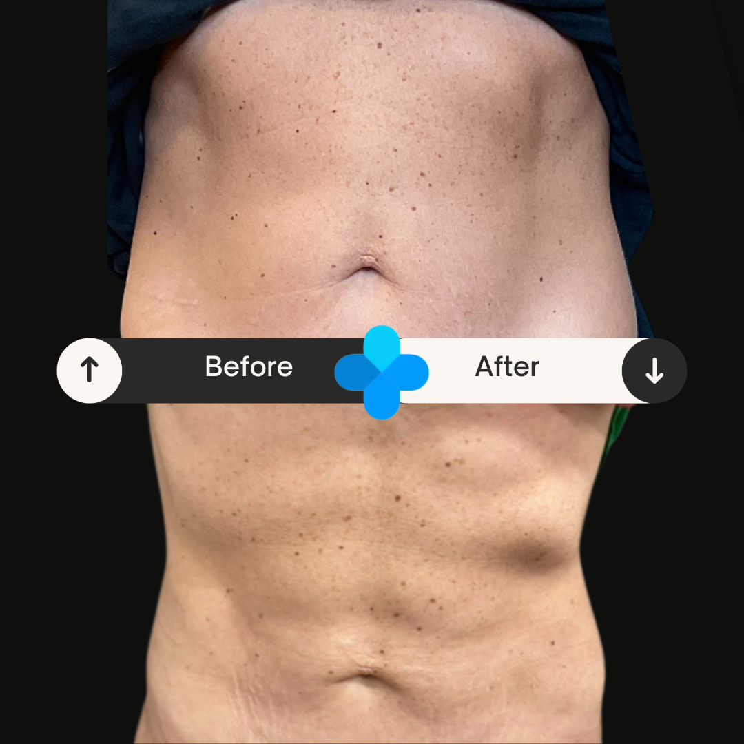 Front view before and after Emsculpt NEO abdominal treatment results