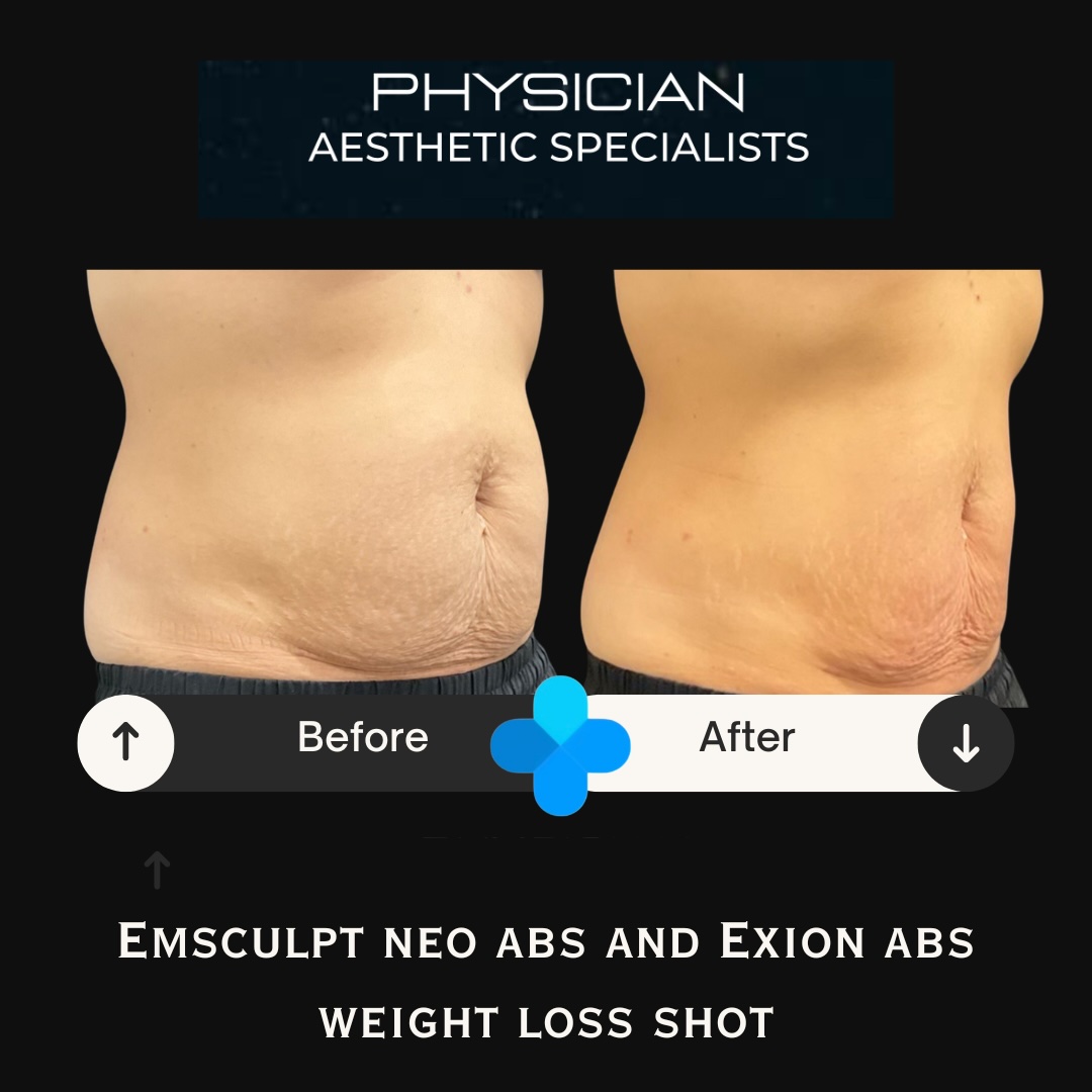 Before and after Emsculpt NEO and Exion abdominal treatment with weight loss