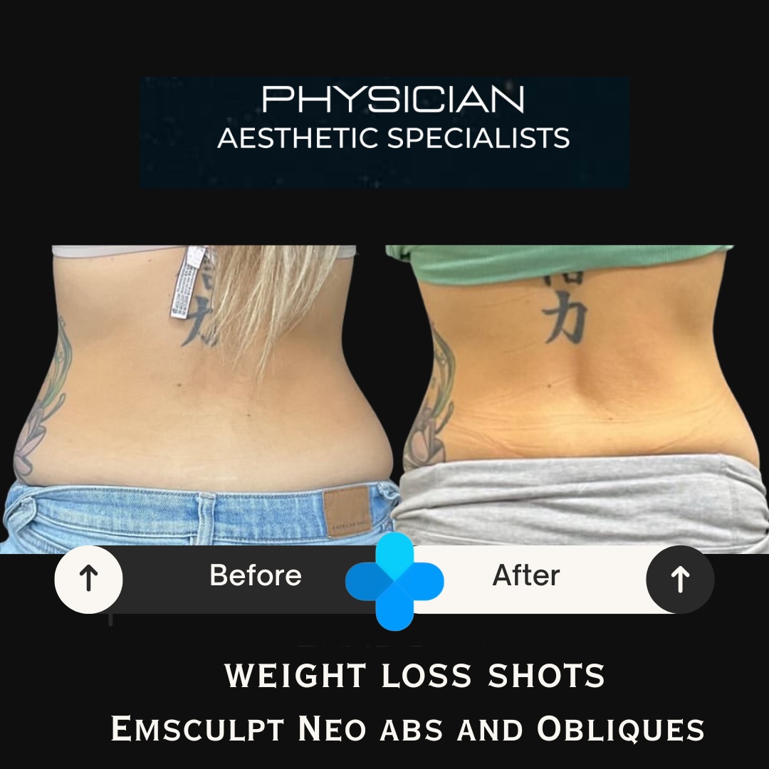 Weight loss before and after result at Physician Aesthetic Specialists
