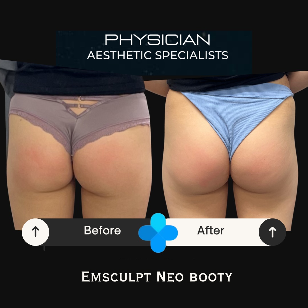 Before and after Emsculpt NEO glute treatment results