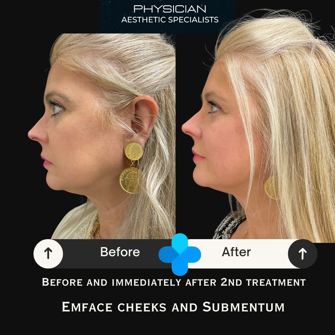 Profile before and after Emface cheek and submental treatment results