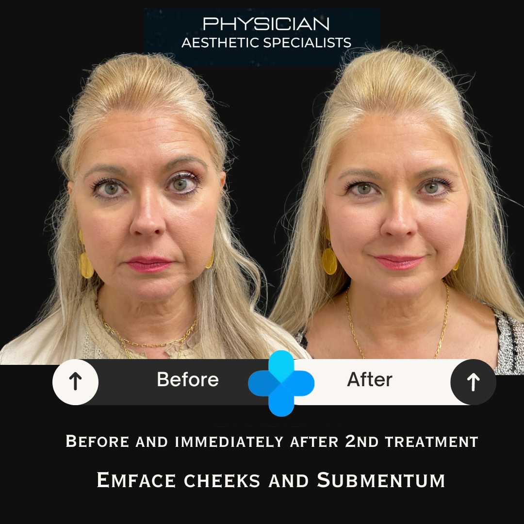 Emface before and after result at Physician Aesthetic Specialists