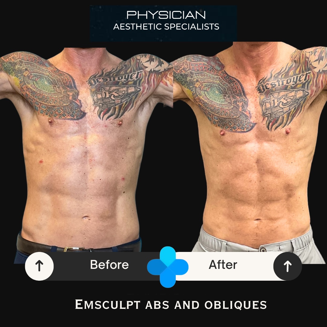Front view before and after Emsculpt NEO abs and obliques treatment results