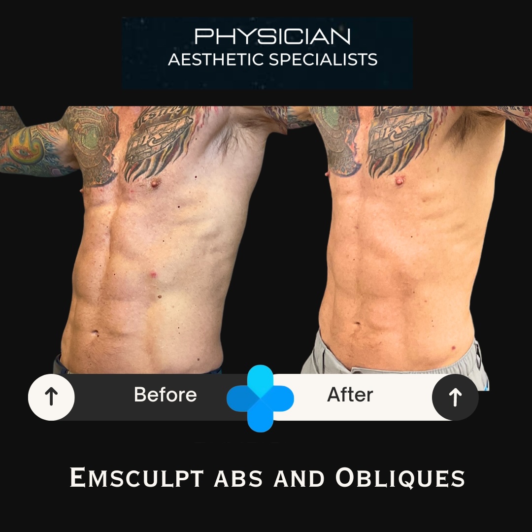 Body contouring before and after result at Physician Aesthetic Specialists