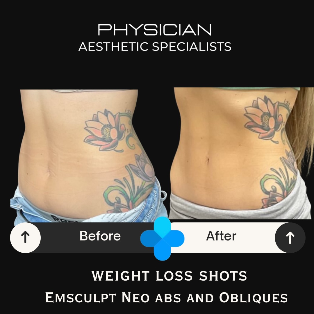 Before and after weight loss and Emsculpt NEO abdominal treatment results
