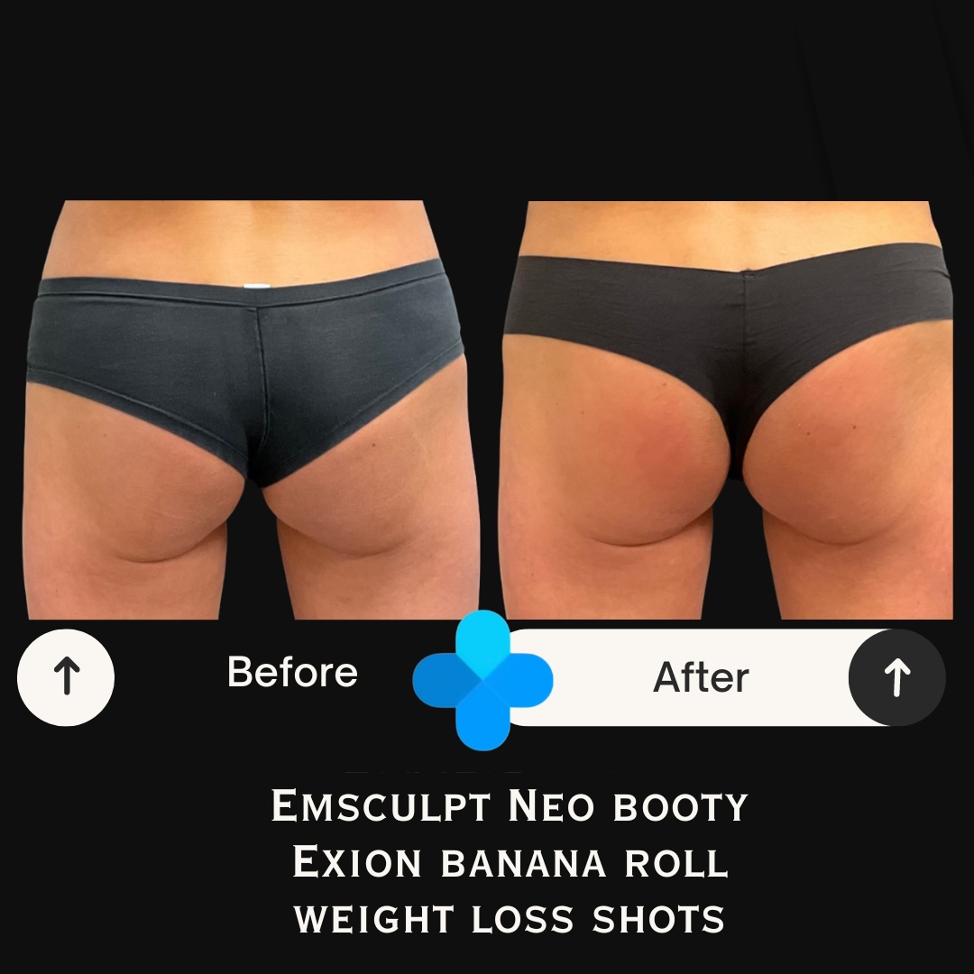 Before and after Emsculpt NEO glute, Exion banana roll, and weight loss results