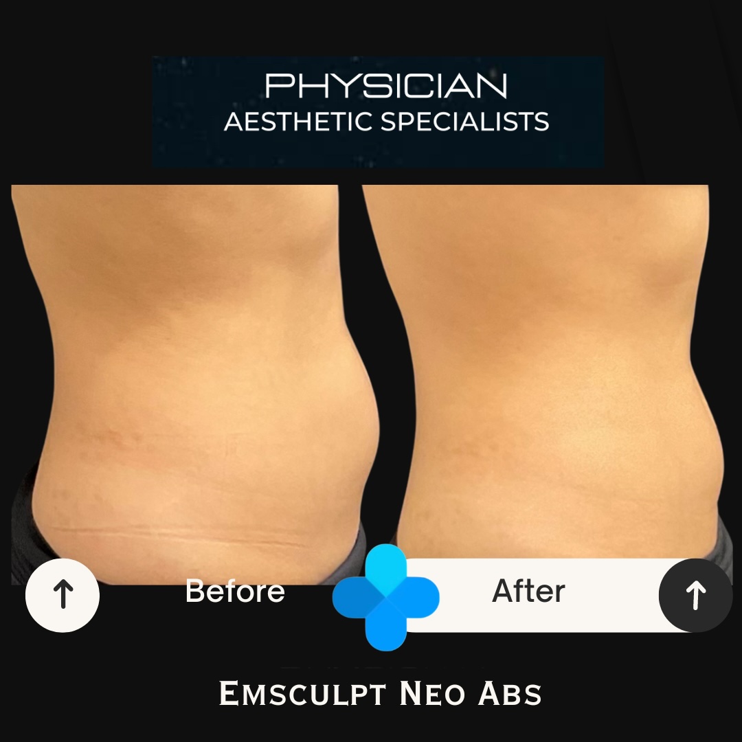 Before and after Emsculpt NEO abdominal contouring results