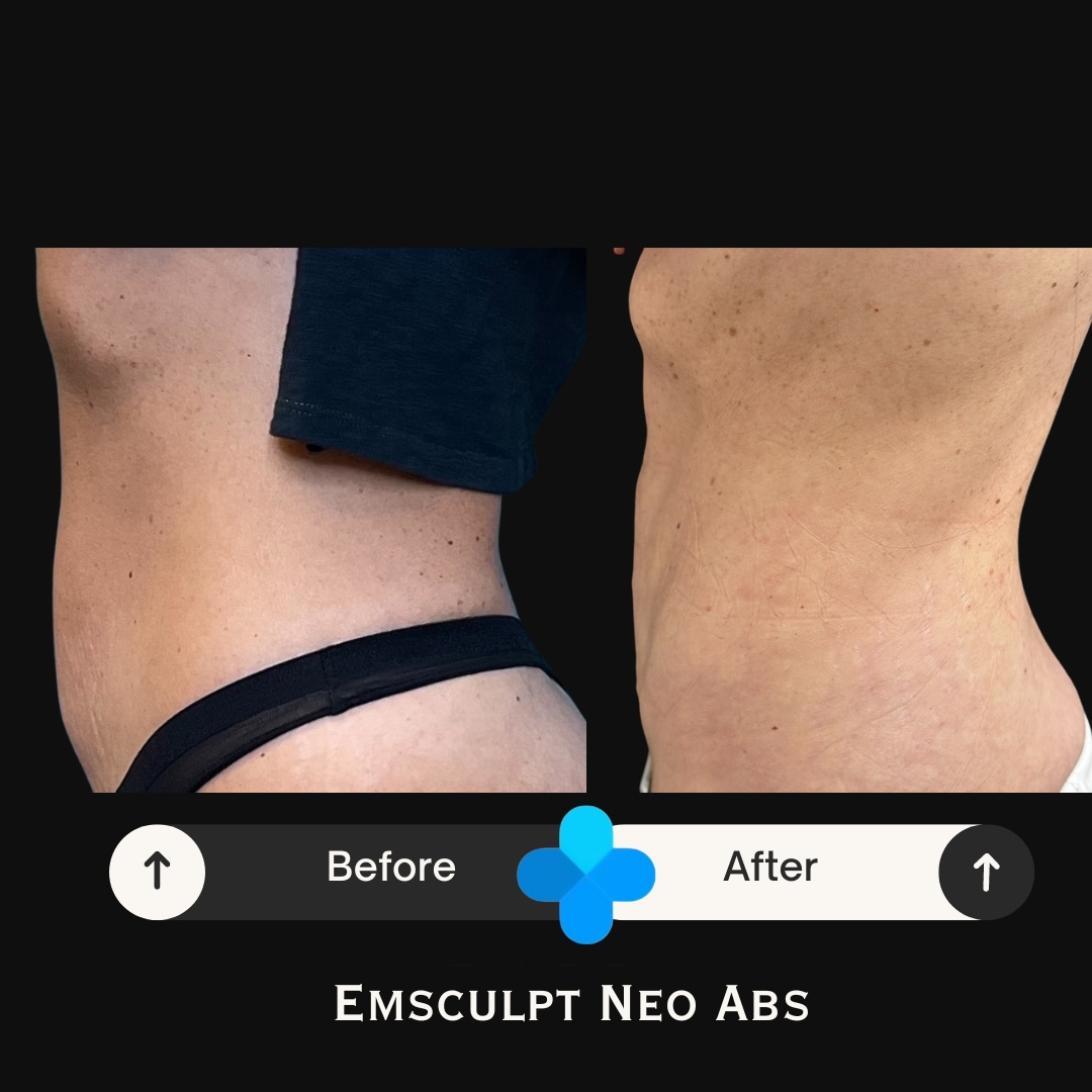Side view before and after Emsculpt NEO abdominal treatment results