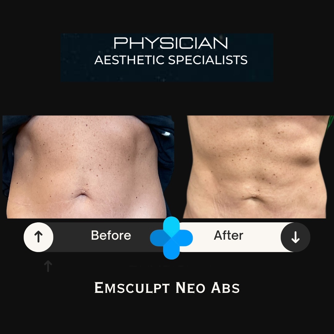 Before and after Emsculpt NEO abdominal treatment results