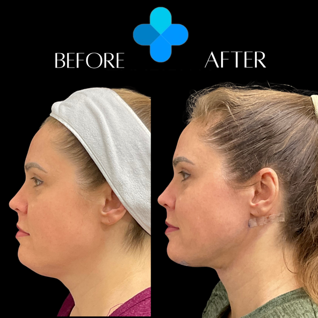 Profile before and after facial contouring results at Physician Aesthetic Specialists