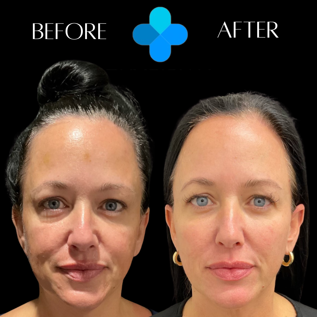 Facial before and after results at Physician Aesthetic Specialists