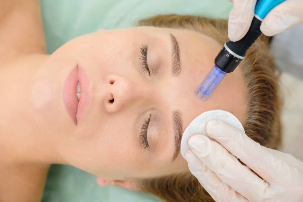 Microneedling device being used on a patient's forehead for skin rejuvenation
