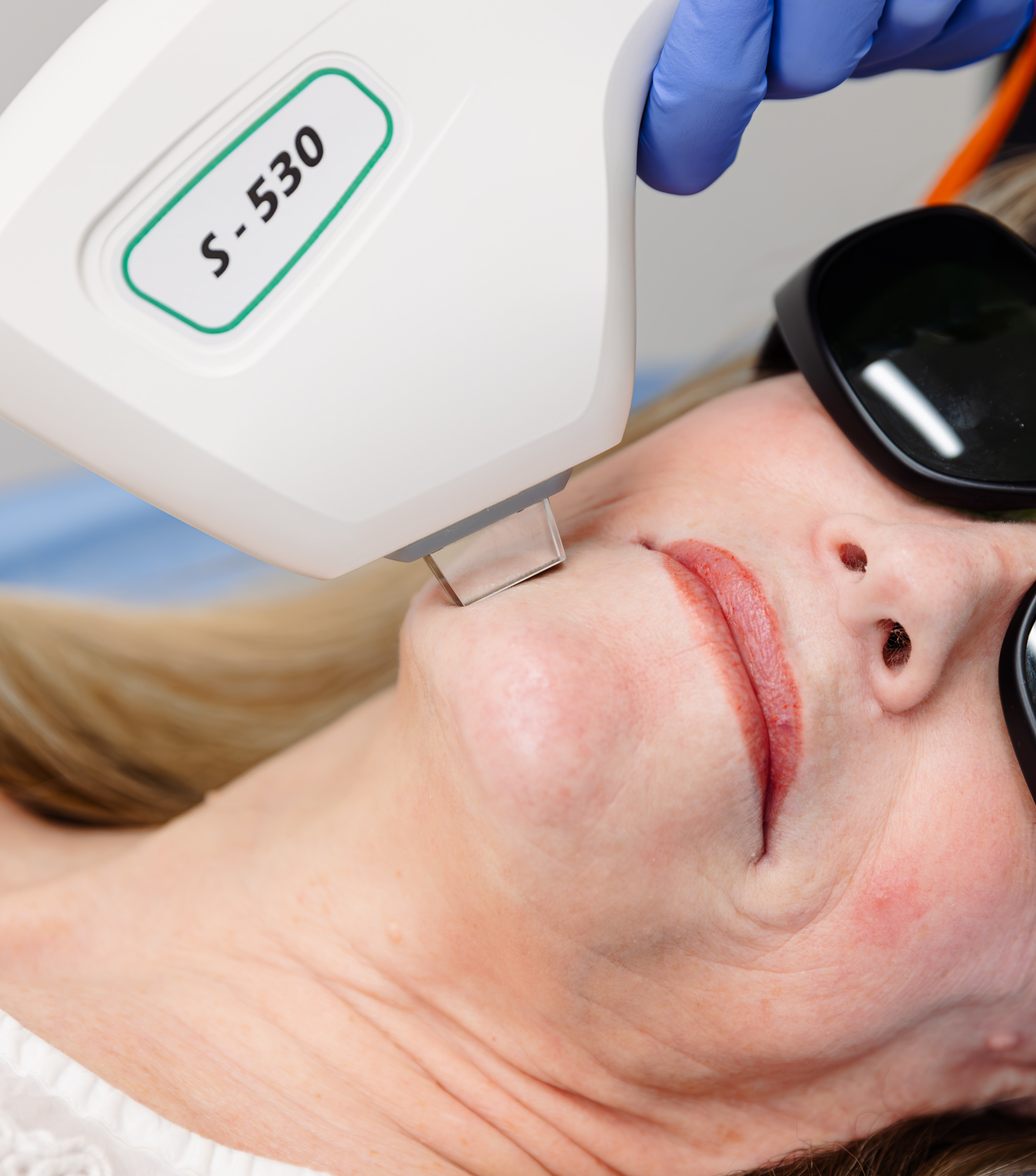 Another patient receives Laser Skin Resurfacing in Lenexa